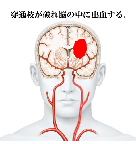 穿通枝が破れ脳の中に出血する。